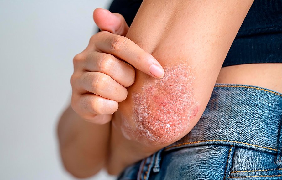 Psoríase: o que é e por que a doença vai além da pele